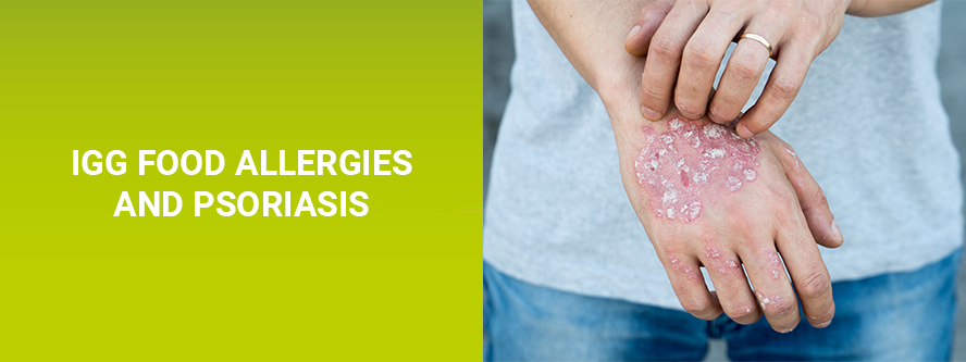 Psoriasis and IgG food allergy